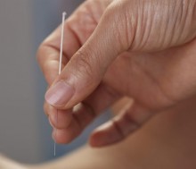 Practica sesiones de acupuntura