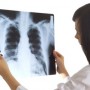 La radiografía torácica 