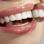 Blanqueamiento dental: ilumina tu sonrisa 