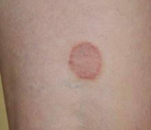 Liquen plano Liquen plano