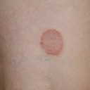 Liquen plano Liquen plano