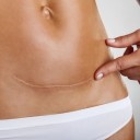 Un bulto en la cicatriz de la cesárea